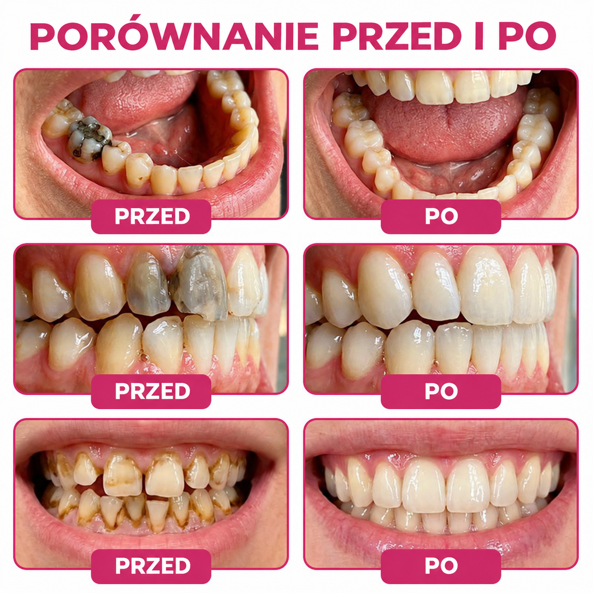 HEATWOLF® DenPerm Żel do wypełniania ubytków zębowych i regeneracji naturalnego szkliwa zębów