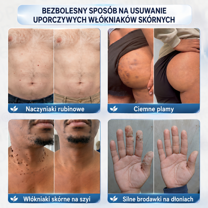 𝐏𝐢𝐜𝐝𝐨® 𝟕-𝐓𝐚𝐠𝐞 𝐇𝐚𝐮𝐭𝐚𝐧𝐡ä𝐧𝐠𝐬𝐞𝐥- & 𝐅𝐥𝐞𝐜𝐤𝐞𝐧-𝐄𝐧𝐭𝐟𝐞𝐫𝐧𝐮𝐧𝐠𝐬𝐜𝐫𝐞𝐦𝐞 (𝐒𝐜𝐡𝐦𝐞𝐫𝐳𝐟𝐫𝐞𝐢𝐞 𝐅𝐨𝐫𝐦𝐞𝐥 – 𝐨𝐡𝐧𝐞 𝐍𝐚𝐫𝐛𝐞𝐧)🍕