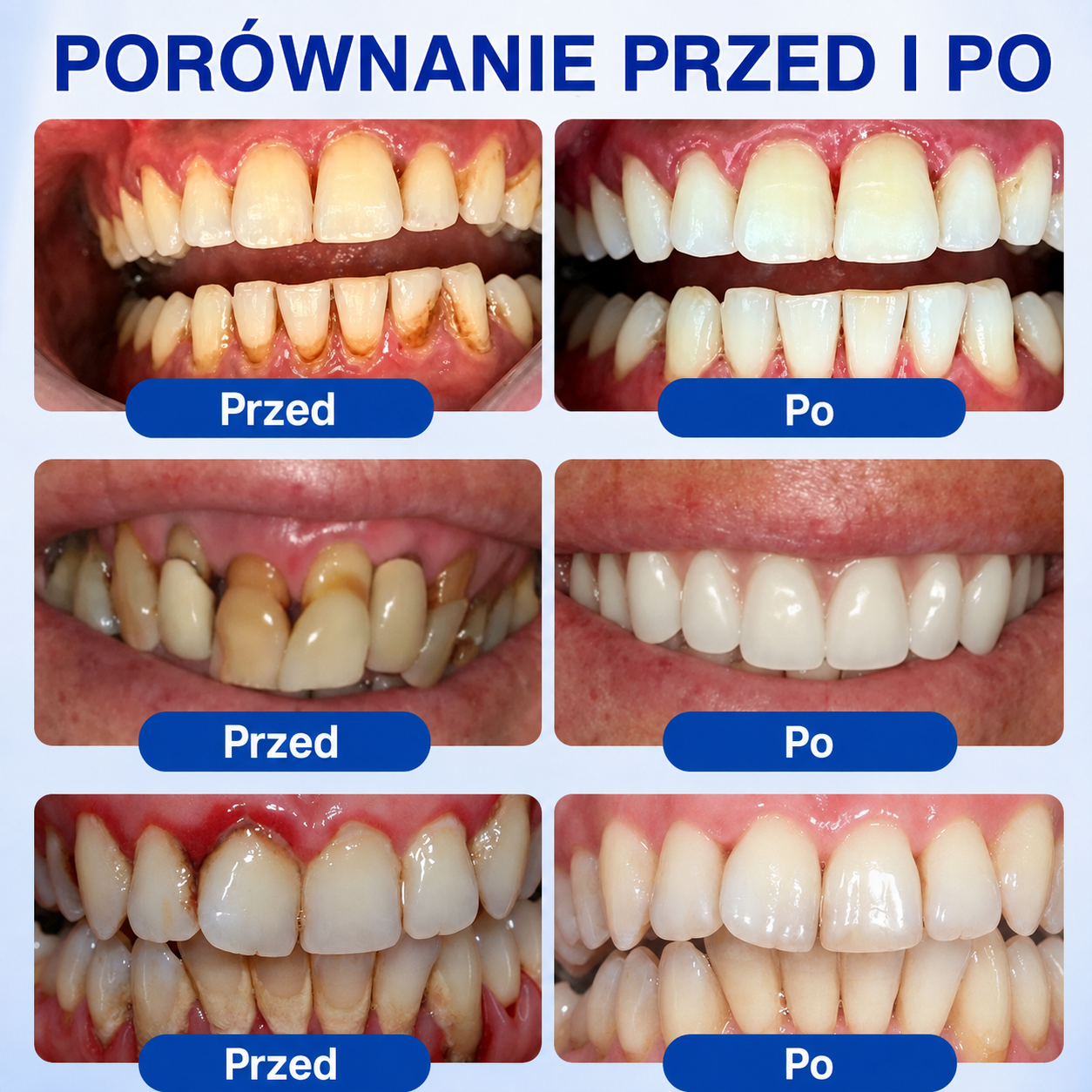 🇵🇱👨‍⚕️✅🦷HEATWOLF® GumRevive Żel naprawczy przy paradontozie🍔