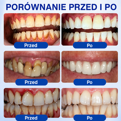 🇵🇱👨‍⚕️✅🦷HEATWOLF® GumRevive Żel naprawczy przy paradontozie🍔