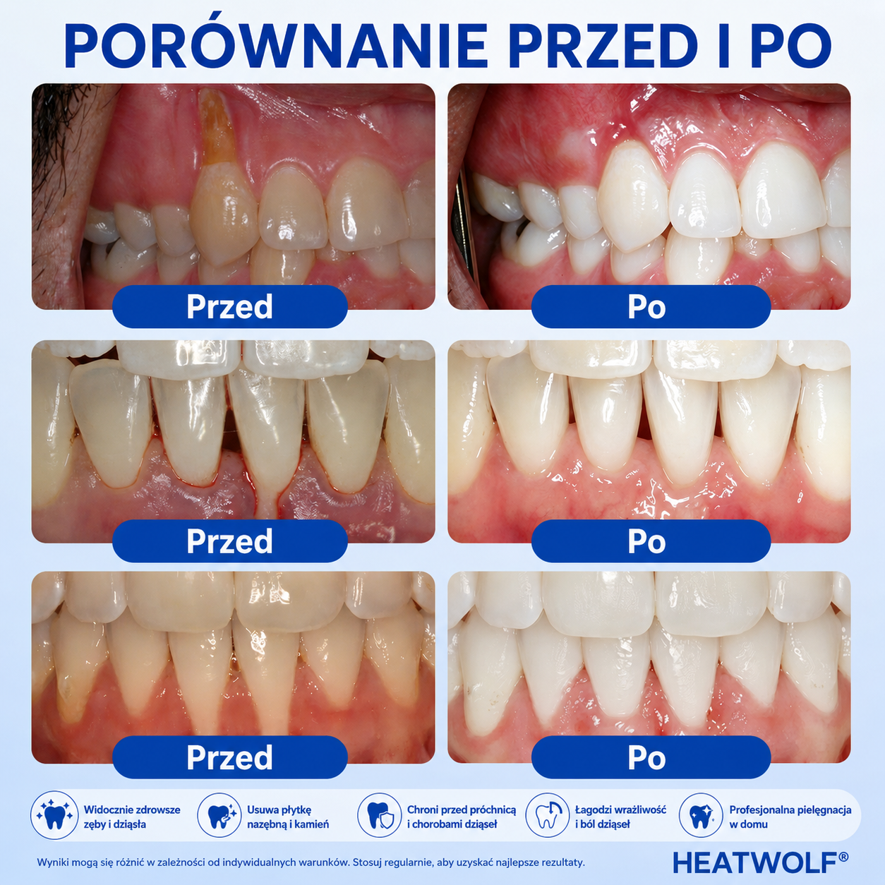 🇵🇱👨‍⚕️✅🦷HEATWOLF® GumRevive Żel naprawczy przy paradontozie🍔
