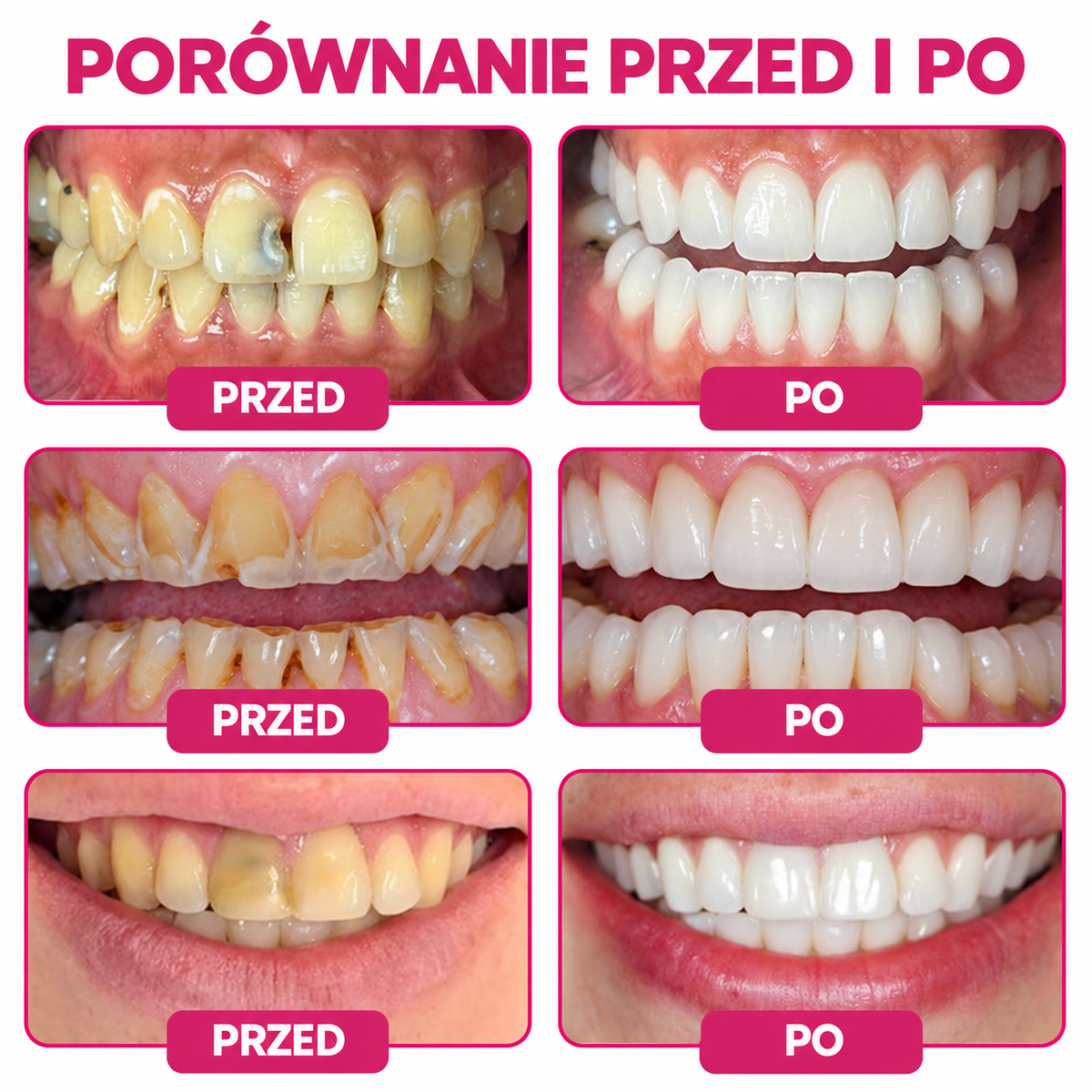 HEATWOLF® DenPerm Żel do wypełniania ubytków zębowych i regeneracji naturalnego szkliwa zębów